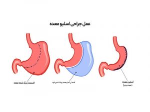 مراقبت های بعد از عمل اسلیو معده